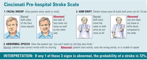 Cincinnati Stroke Scale : PPT - Neurological Assessment of The Suspected Stroke ... - Maybe you ...