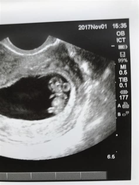 Baby At 8 Weeks Ultrasound - Baby Viewer