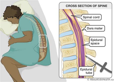 Should I Get an Epidural During Labor? - NYSORA