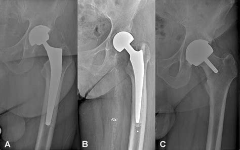 Bipolar Hemiarthroplasty Vs Total Hip Replacement