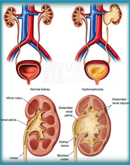 Best Cost Laparoscopic pyeloplasty Surgery in India Top Hospital Surgeon Delhi, Mumbai, Chennai ...