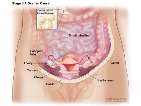 IP Chemo for Ovarian Cancer is Underused - NCI