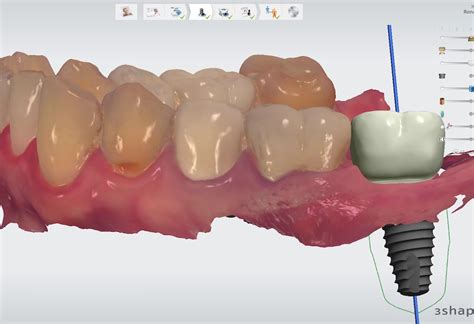 1. Molar dental implant digital dentistry kazemi oral surgery bethesda MD | 1. Molar dental ...