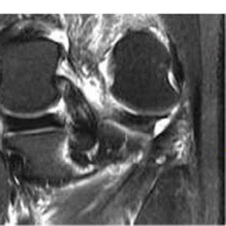 Preoperative MRI (sagittal, coronal, and axial, respectively ...