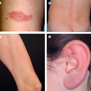 Examples of erythema migrans (A) Erythema migrans on a patient's right ...