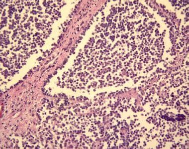 Pathology - Rhabdomyosarcoma: Practice Essentials, Histology, Presentation and Evaluation