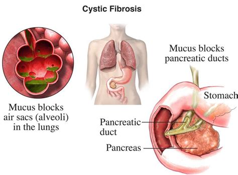 Cystic Fibrosis | Lung and Thoracic Treatment in New Jersey