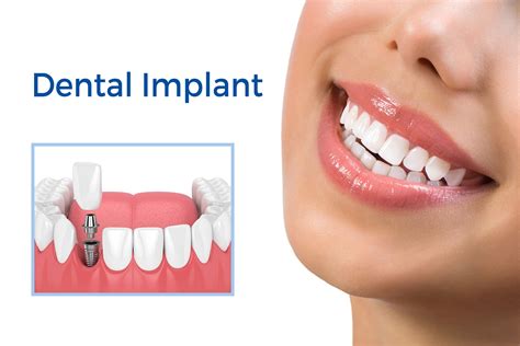 Accomplish Your Smile with Dental Implants - Aesthetix Dental Care Surat