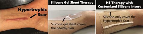 Differences between the suggested hypertrophic scars (HS) treatment... | Download Scientific Diagram