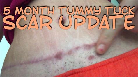 5 MONTH TUMMY TUCK SCAR UPDATE - YouTube