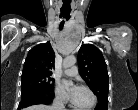 Substernal goiter | Radiology Case | Radiopaedia.org