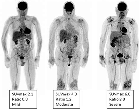 FDG-PET. Low (grade 1), intermediate (grade 2), and high (grade 3) FDG... | Download Scientific ...