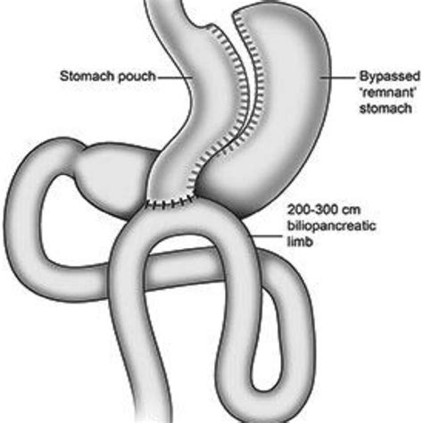 Diagram of Billroth II gastrectomy. | Download Scientific Diagram