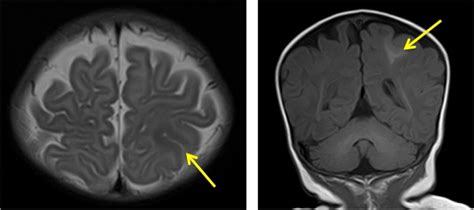 Focal cortical dysplasia – Radiology Cases