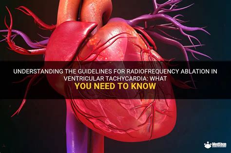 Understanding The Guidelines For Radiofrequency Ablation In Ventricular Tachycardia: What You ...