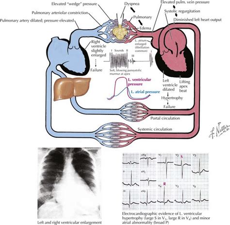 Mitral Valve Disease | Thoracic Key