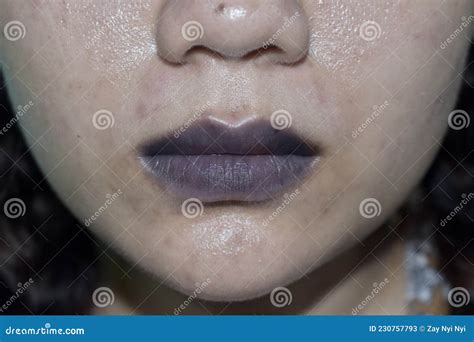 Labios Cianoticos O Cianosis Central En La Joven Mujer Del Sudeste ...