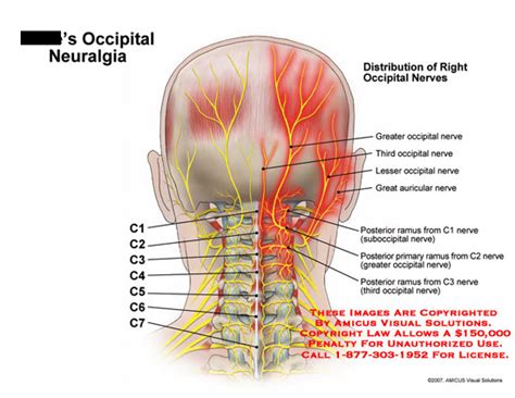 Occipital Neuralgia | Occipital neuralgia, Neuralgia, Occipital nerve block