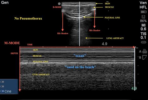 Lung Ultrasound – Pocket ICU