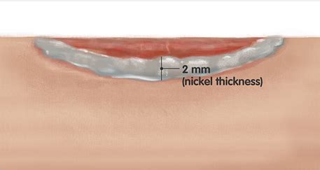 How to apply | Collagenase SANTYL Ointment for HCPs