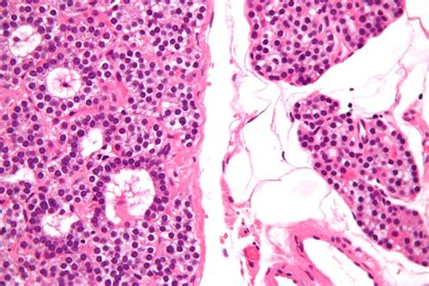 Hyperparathyroidism pathophysiology - wikidoc