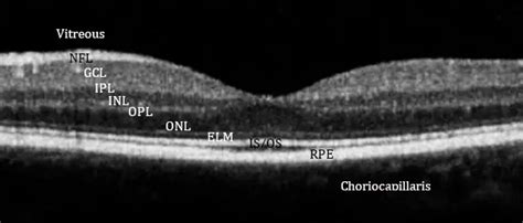 4 Tips for Assessing the Macular OCT Scan - American Academy of Ophthalmology