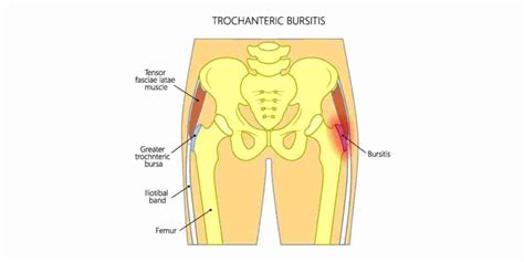 Hip Pain Location Chart Mayo Clinic