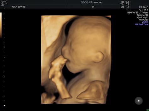 20 week ultrasound 3d pictures - booyopen