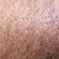 What Is Weeping Eczema?