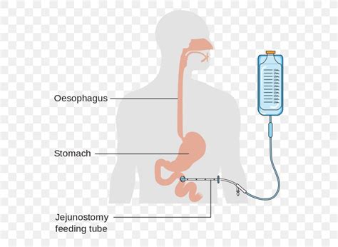 Jejunostomy Feeding Tube Percutaneous Endoscopic Gastrostomy Nasogastric Intubation, PNG ...