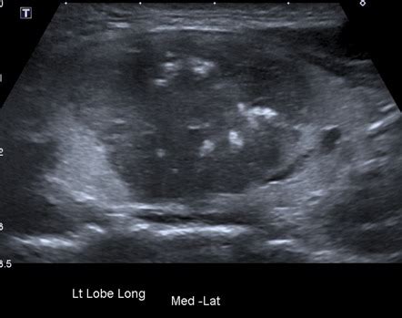 Follicular Thyroid Cancer Ultrasound