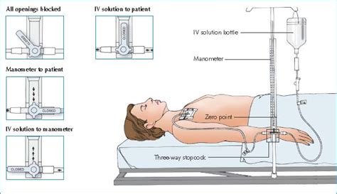 Central Venous Pressure Monitoring | Nurse Key