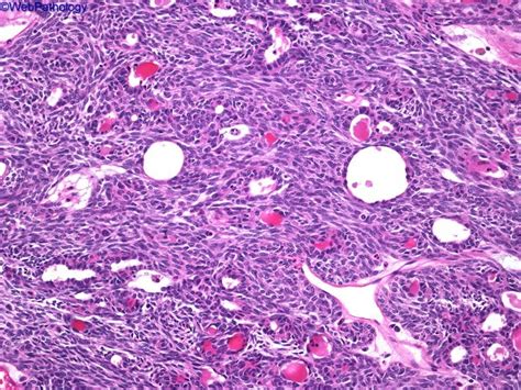 type a thymoma thymus histology