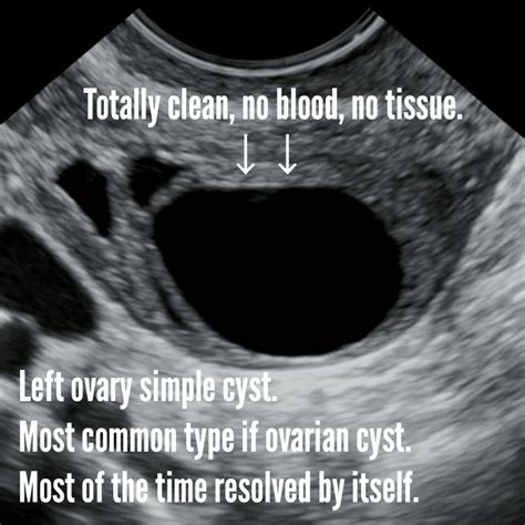 Hemorrhagic cyst. Cause, symptoms, complications, ultrasound. - Ultrasoundfeminsider