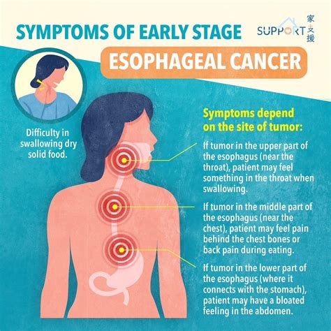 Esophageal Cancer: Symptoms More, 51% OFF