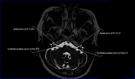 5th Cranial Nerve Mri