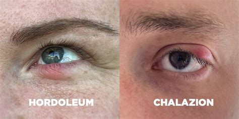 Hordeolum Vs Chalazion