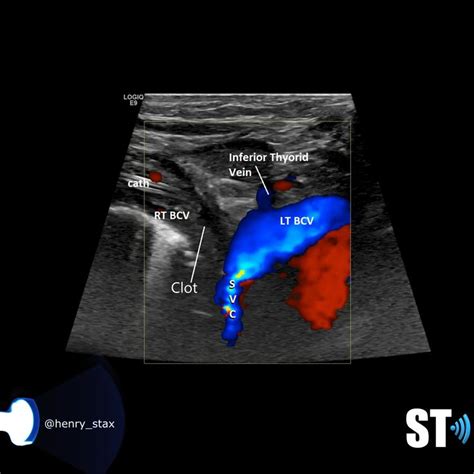 Upper Extremity Venous Doppler – Sonographic Tendencies | Medical ...