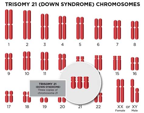 Trisomy 21 (Down Syndrome) | Cardinal Glennon