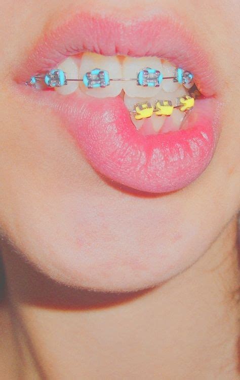 27 Braces ideas | orthodontics, dental braces, dentistry