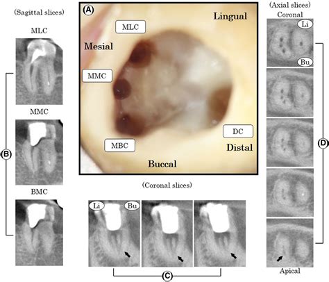 Pdf A Mandibular Second Molar With A Middle Mesial Root Canal | My XXX Hot Girl