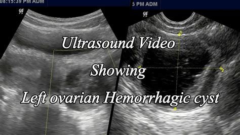 Ovarian Hemorrhagic Cyst Ultrasound - YouTube