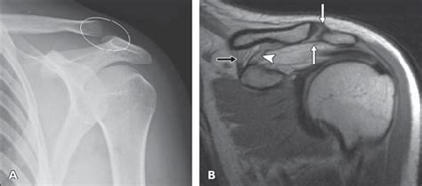 year-old woman after left-sided acromioclavicular joint trauma with... | Download Scientific Diagram