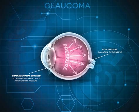 Diet may lower glaucoma subtype risk by 20 percent, researchers say | Fox News