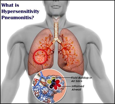 Hypersensitivity Pneumonitis | Hypersensitivity, Pulmonary fibrosis, Lung disease