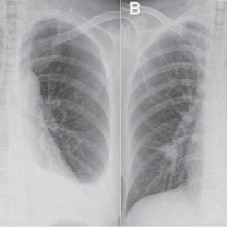 A) Newly developed left-sided chylothorax as a result of copious... | Download Scientific Diagram