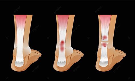 Diagram Showing Broken Bone In Human Foot Illustration Broken Bone Vector, Illustration, Broken ...