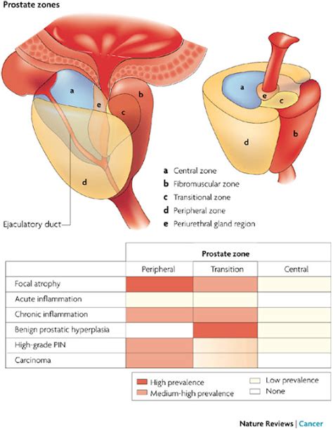 Doctors Gates: Prostate diseases in relation to Prostate zones