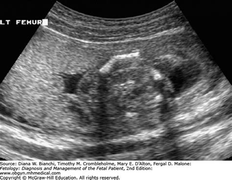 Campomelic Dysplasia | Obgyn Key