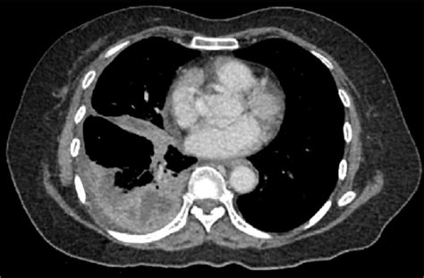 Axial CT scan with contrast of the lower thorax on re-admission.The ...